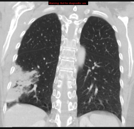 File:Bronchoalveolar carcinoma (BAC) (Radiopaedia 13436-13392 Coronal lung window 43).jpg