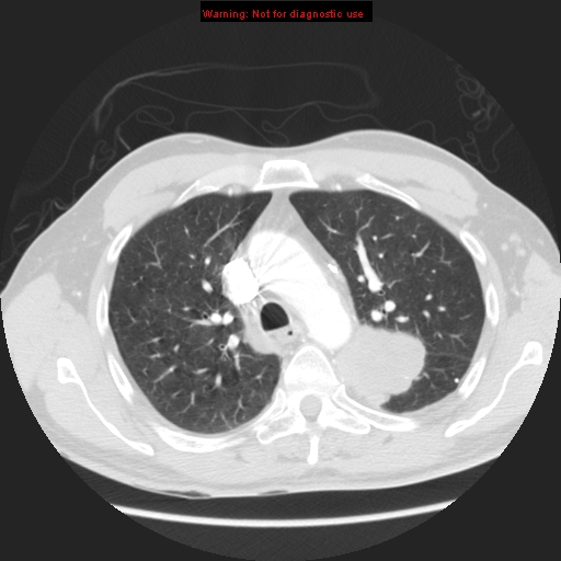 File:Bronchogenic carcinoma brain metastasis (Radiopaedia 9286-105832 Axial lung window 15).jpg