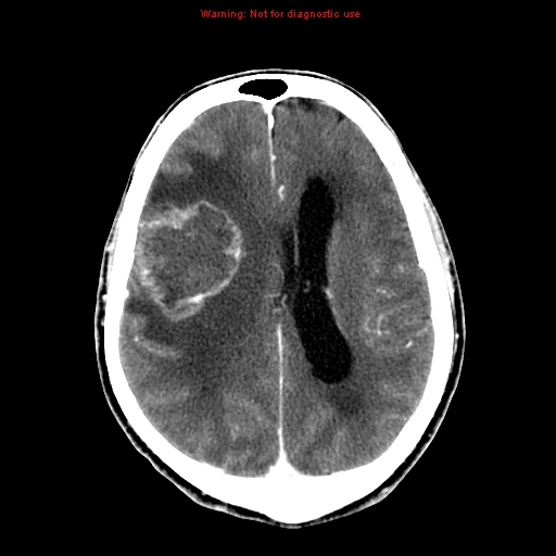 File:Bronchogenic carcinoma brain metastasis (Radiopaedia 9286-9970 B 18).jpg