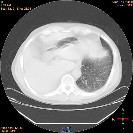 File:Bronchogenic carcinoma with superior vena caval invasion (Radiopaedia 22378-22406 lung window 20).jpg