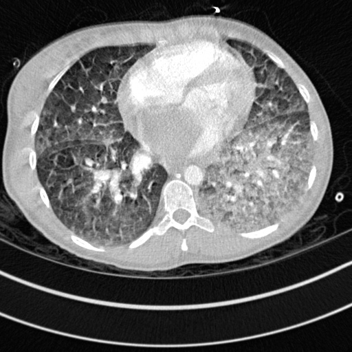 Bronchogenic cyst (Radiopaedia 77801-90071 Axial lung window 55).jpg