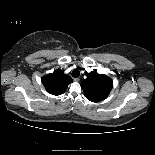 Bronchogenic cyst - posterior mediastinal (Radiopaedia 43885-47364 A 9).jpg