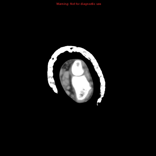 Brown tumor (Radiopaedia 12460-12694 Axial non-contrast 20).jpg