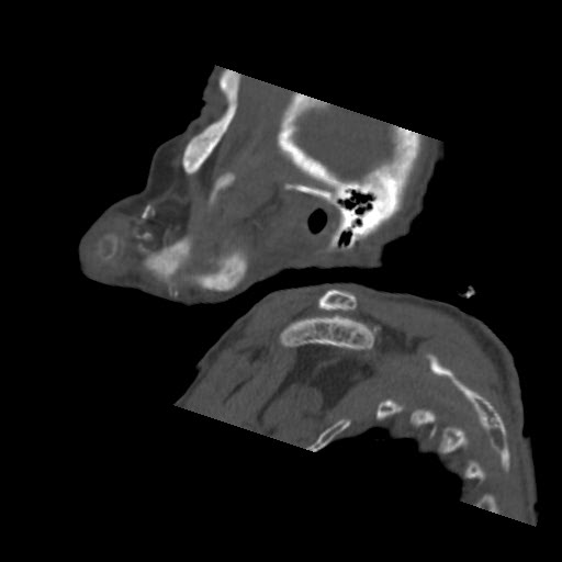 File:Brown tumor with secondary hyperparathyroidism (Radiopaedia 23591-23705 B 11).jpg