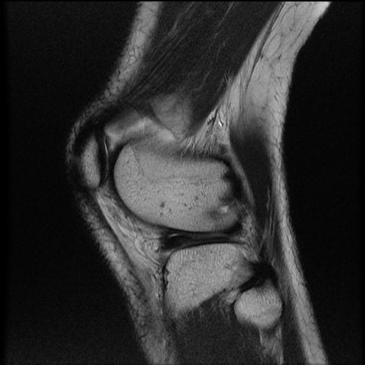 File:Bucket-handle meniscus tear (Radiopaedia 65700-74809 Sagittal T2 21).jpg