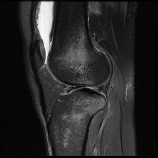 File:Bucket handle meniscus tear (Radiopaedia 56916-63751 Sagittal PD fat sat 7).jpg