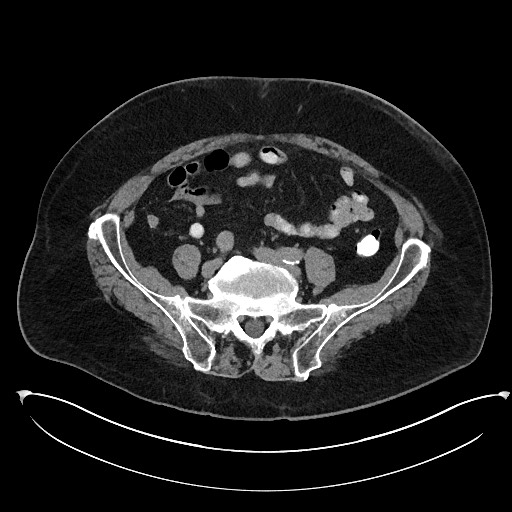 File:Buried bumper syndrome - gastrostomy tube (Radiopaedia 63843-72577 Axial Inject 88).jpg