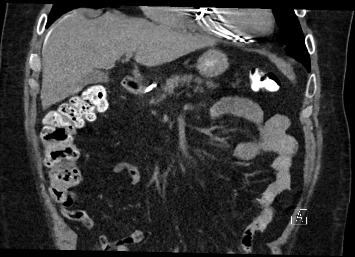 Buried bumper syndrome - gastrostomy tube (Radiopaedia 63843-72577 Coronal Inject 51).jpg