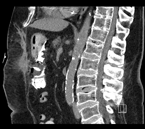 Buried bumper syndrome - gastrostomy tube (Radiopaedia 63843-72577 Sagittal Inject 60).jpg