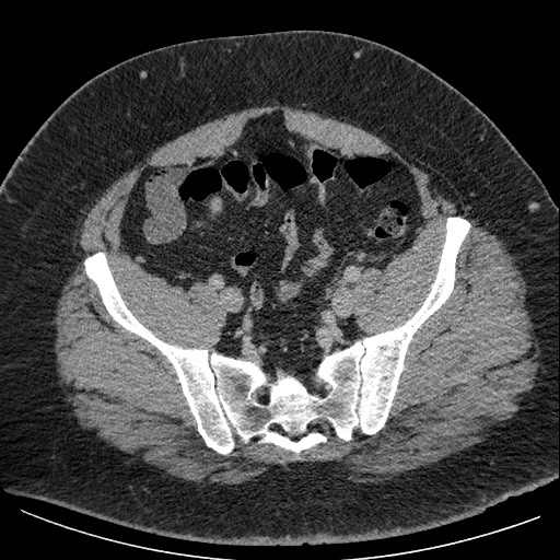 File:Burned-out testicular seminoma - retroperitoneal nodal metastases (Radiopaedia 62872-71245 A 58).jpg