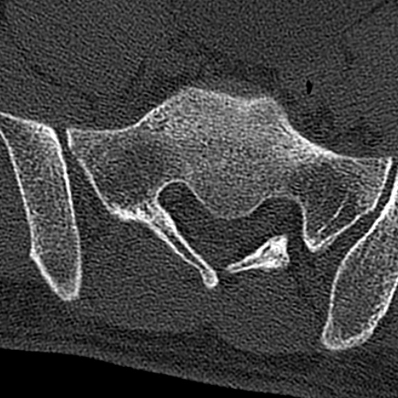 File:Burst fracture (Radiopaedia 53373-59357 Axial bone window 71).jpg