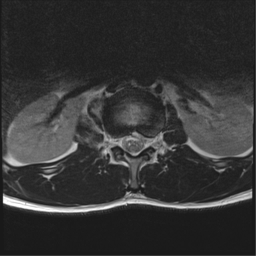File:Burst fracture - T12 with conus compression (Radiopaedia 56825-63646 Axial T2 11).png
