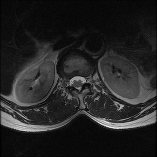 File:Burst fracture - lumbar spine (Radiopaedia 72877-83541 Axial T2 2).jpg