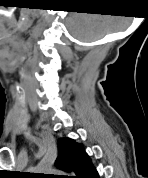 C2 fracture with vertebral artery dissection (Radiopaedia 37378-39199 D 25).png