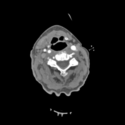 C2 fracture with vertebral artery dissection (Radiopaedia 37378-39200 A 139).png