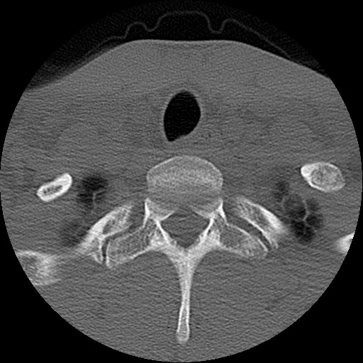 File:C5 facet fracture (Radiopaedia 58374-65499 Axial bone window 87).jpg