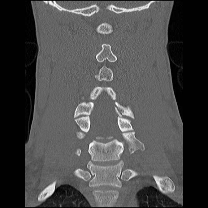 C5 facet fracture (Radiopaedia 58374-65499 Coronal bone window 36).jpg