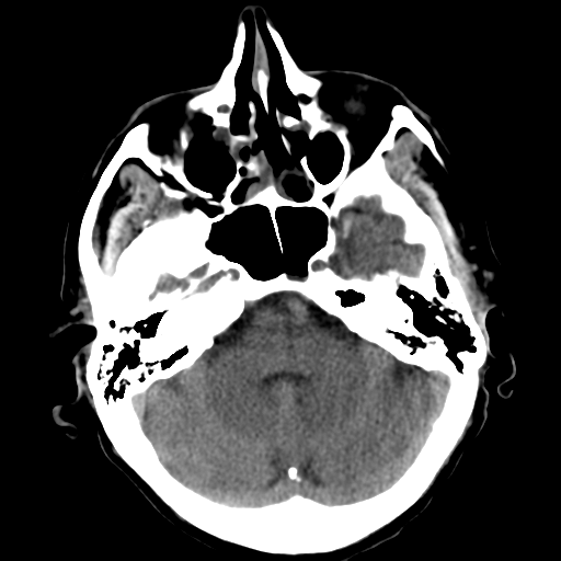 File:CNS lymphoma (Radiopaedia 36983-38639 Axial non-contrast 12).png
