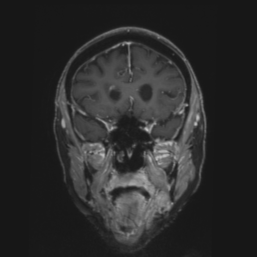 CNS lymphoma with steroid response (Radiopaedia 37980-39921 Coronal T1 C+ 12).png