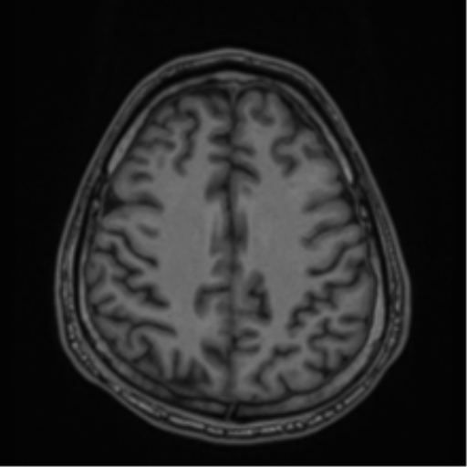CNS vasculitis (Radiopaedia 55715-62263 Axial T1 66).png