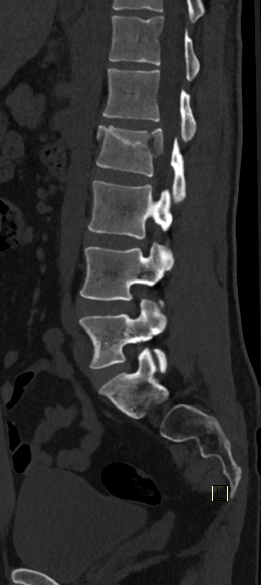 Calcaneal fractures with associated L2 burst fracture (Radiopaedia 71671-82493 Sagittal bone window 28).jpg