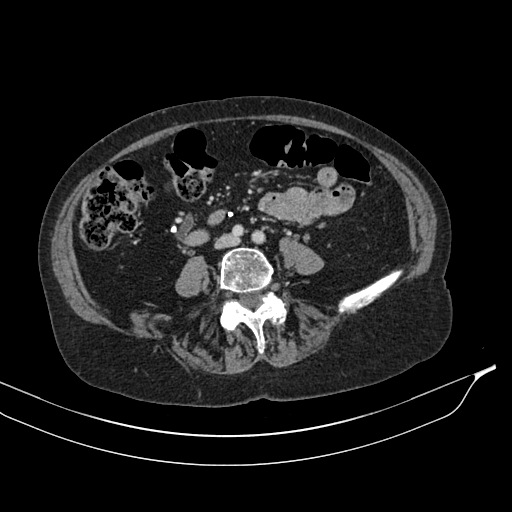 Calcified adrenal glands and Spigelian hernia (Radiopaedia 49741-54988 A 135).jpg