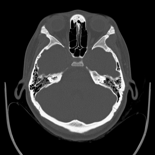 Calvarial osteoma (Radiopaedia 36520-38079 Axial bone window 31).jpg