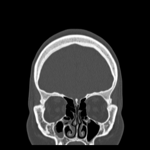 Calvarial osteoma (Radiopaedia 36520-38079 C 21).jpg
