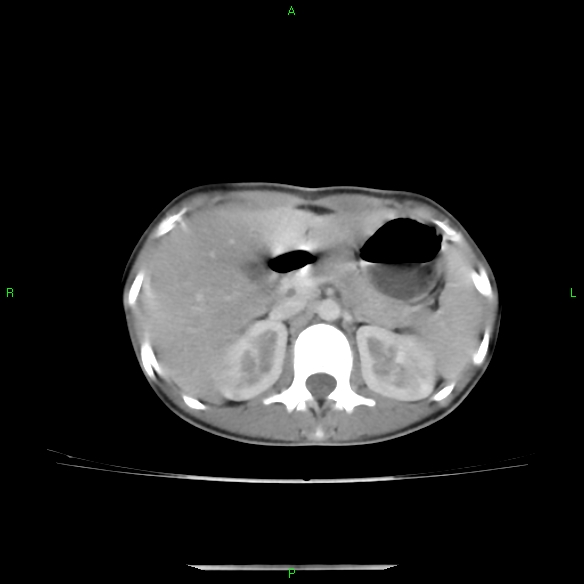 File:Cannon ball metastases - synovial sarcoma (Radiopaedia 26135-26271 C 39).jpg