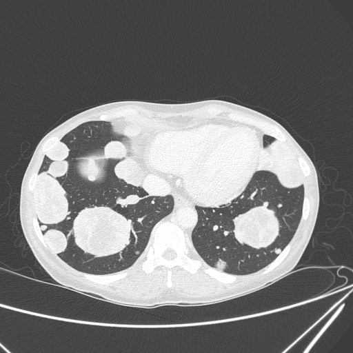 Canonball lung metastasis (Radiopaedia 77634-89837 Axial lung window 137).jpg