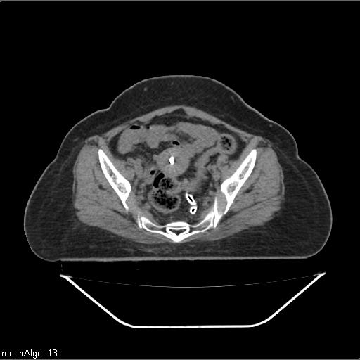 Carcinoma cervix- brachytherapy applicator (Radiopaedia 33135-34173 Axial non-contrast 19).jpg