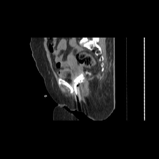 File:Carcinoma cervix- brachytherapy applicator (Radiopaedia 33135-34173 D 71).jpg