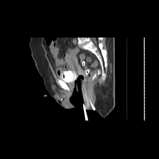 File:Carcinoma cervix- brachytherapy applicator (Radiopaedia 33135-34173 D 95).jpg