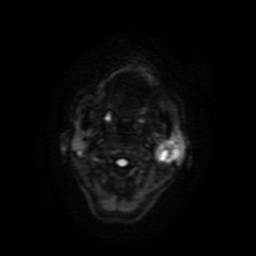 Carcinoma ex-pleomorphic adenoma of parotid (Radiopaedia 28383-28627 Ax DWI B-500 GE 53).jpg