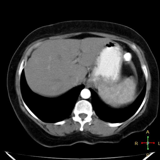 File:Carcinoma of sigmoid colon (Radiopaedia 23071-23100 C+ arterial phase 4).jpg
