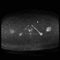 Carcinoma of the cervix (Radiopaedia 89018-105858 Axial DWI 66).jpg