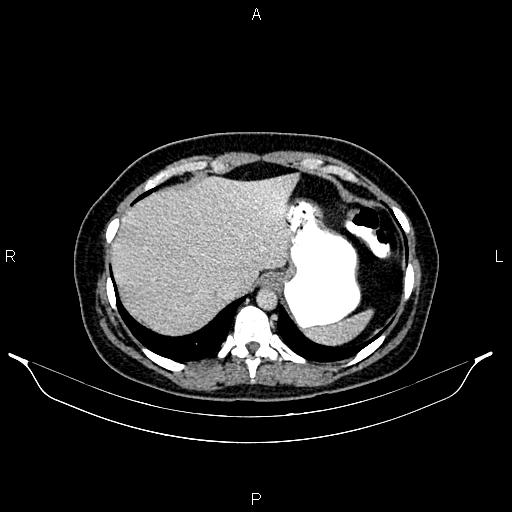 Carcinoma of uterine cervix (Radiopaedia 85861-101700 A 31).jpg