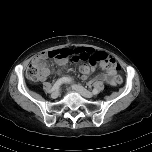Carcinosarcoma (Radiopaedia 70401-80503 A 45).jpg