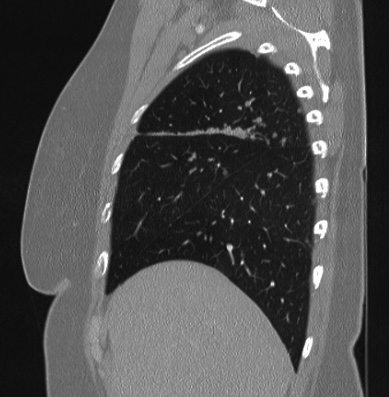 Cardiac sarcoidosis (Radiopaedia 74548-85534 Sagittal lung window 75).jpg
