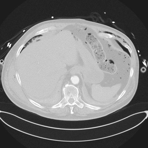 Cardiac trauma (Radiopaedia 32874-33858 Axial lung window 48).jpg