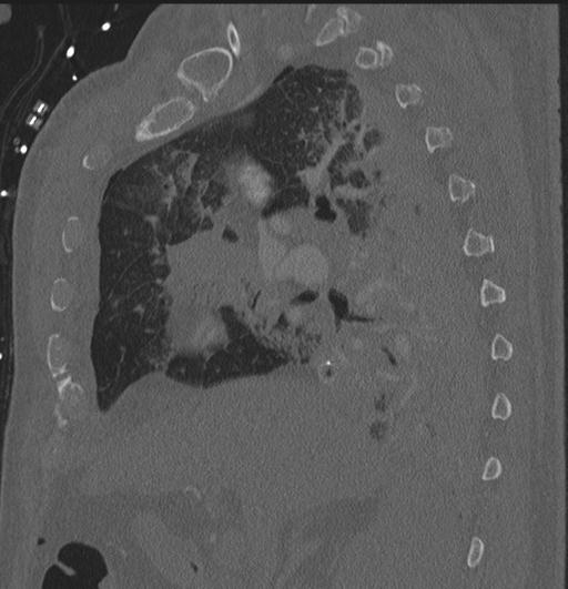 File:Cardiac trauma (Radiopaedia 32874-33858 Sagittal bone window 70).jpg
