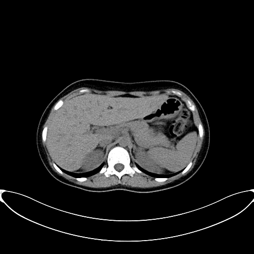 Caroli disease with medullary sponge kidney (Radiopaedia 82622-96804 Axial non-contrast 21).jpg