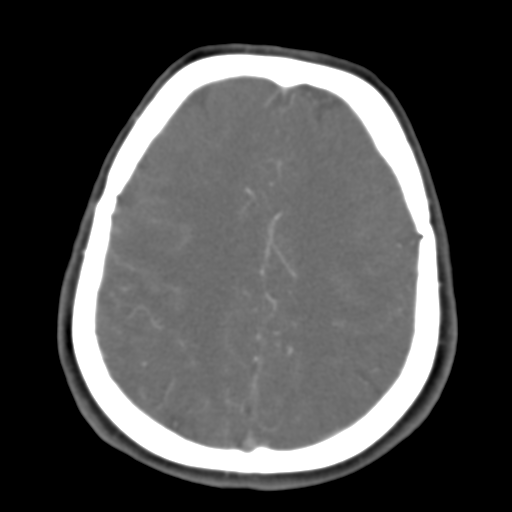 Carotico ophthalmic aneurysm (Radiopaedia 42916-46148 A 16).png