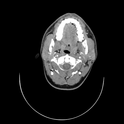 File:Carotid bulb pseudoaneurysm (Radiopaedia 57670-64616 A 15).jpg
