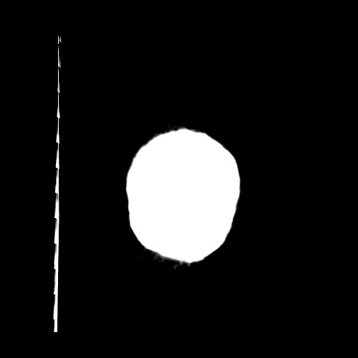 Carotid near-occlusion (Radiopaedia 85304-100887 Coronal non-contrast 72).jpg