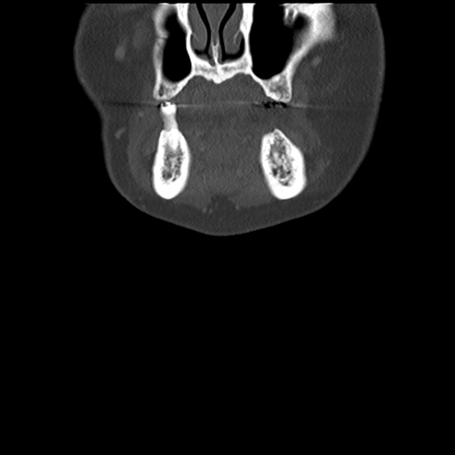 Causes of dysphagia (Radiopaedia 40149-42657 Coronal bone window 12).png