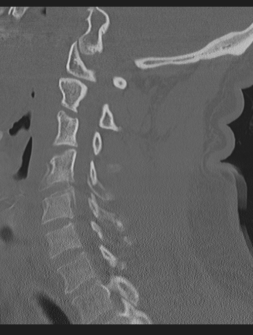 Cavernoma of cervical cord (Radiopaedia 50838-56346 Sagittal bone window 48).png