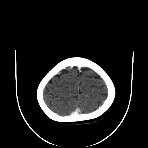 File:Cavernoma with developmental venous anomaly (Radiopaedia 22470-22506 C+ arterial phase 30).jpg