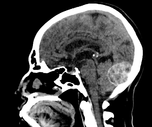 Cavernous hemangioma of the cerebellar falx (Radiopaedia 73025-83723 B 165).jpg