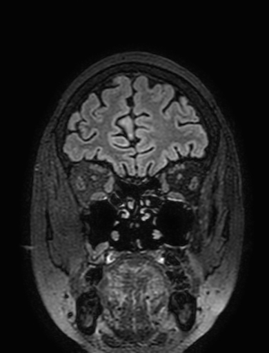 Cavernous hemangioma of the cerebellar falx (Radiopaedia 73025-83724 Coronal FLAIR 62).jpg